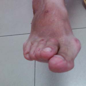 类风湿关节变形图片5