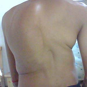 轻度脊柱侧弯图片8