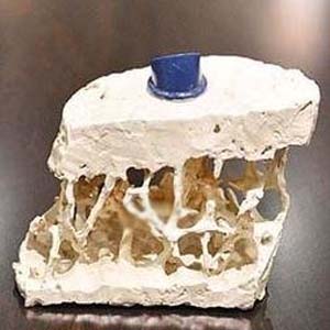 骨质疏松图片2