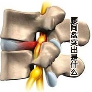 腰间盘突出图片1