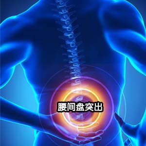 腰间盘突出示意图4