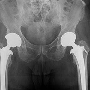 双侧股骨头坏死图片5