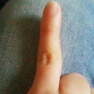 手指腱鞘炎图片4