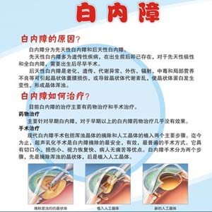 白内障宣传图