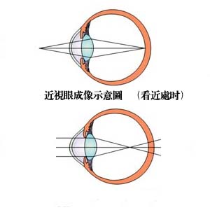 近视眼成像示意图5
