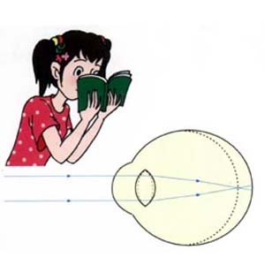 近视眼卡通图片1