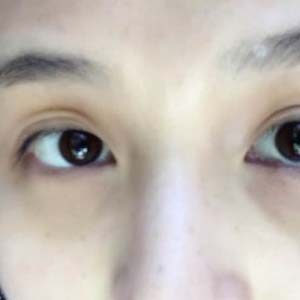 近视眼眼睛变形图片