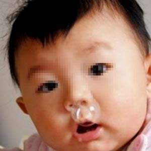 儿童鼻息肉图片2