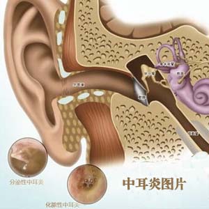 中耳炎图解