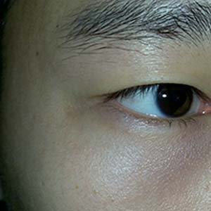 青光眼眼睛图片8