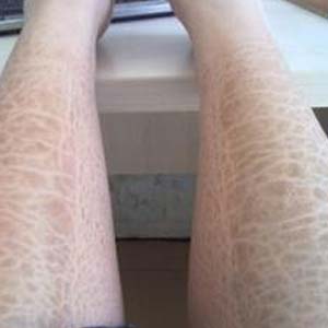 女性鱼鳞病图片5