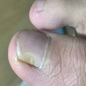 轻微灰指甲图片5