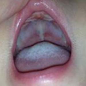 白色念珠菌病图片1