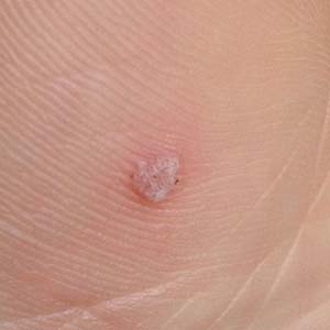 鸡眼膏贴治疗过程图1