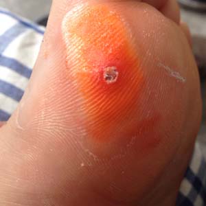 鸡眼膏贴治疗过程图8